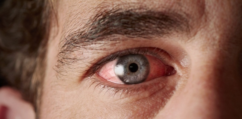 Glaucoma symptoms 
