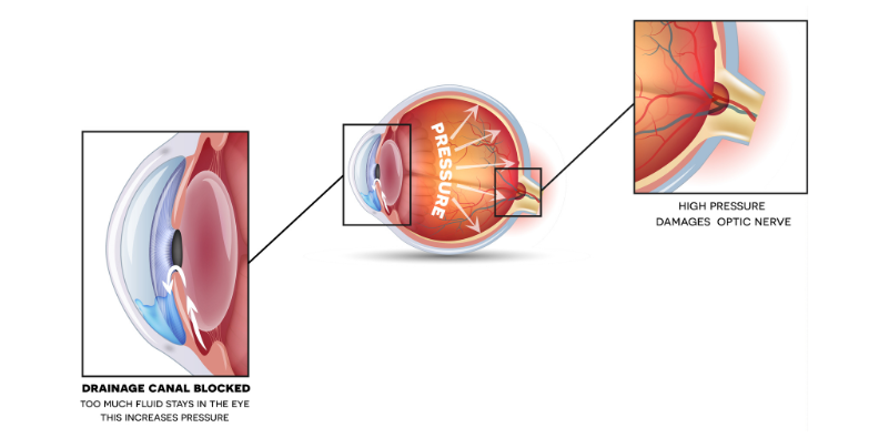 intraocular pressure